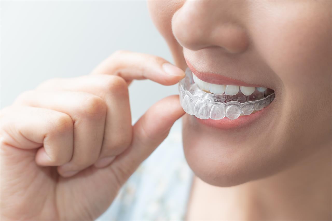 ¿Conoce los tipos de ortodoncia que existen? ¿Cuál elegir? - Imagen 1