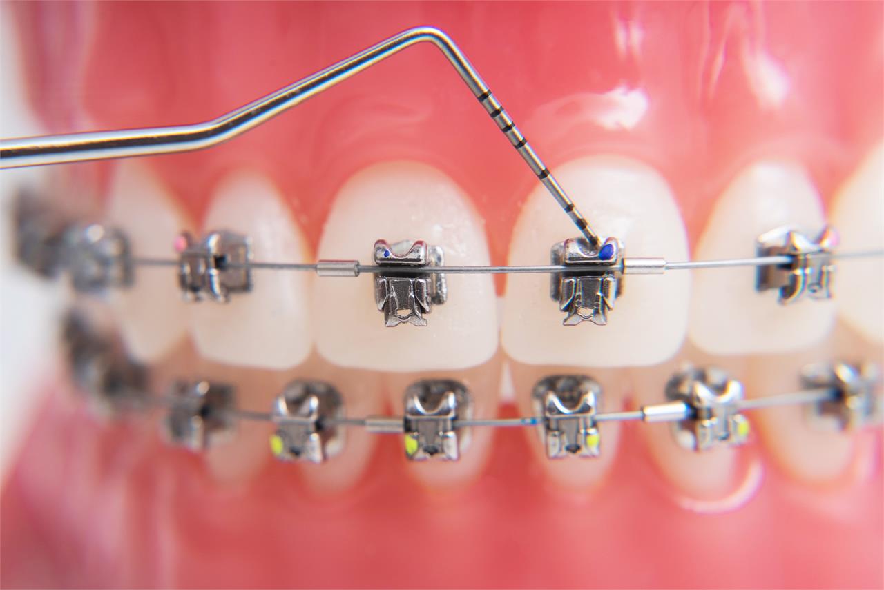 ¿Conoce los tipos de ortodoncia que existen? ¿Cuál elegir? - Imagen 2