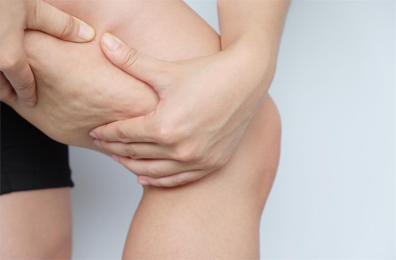 ¿Conoces los mejores tratamientos para eliminar la celulitis?