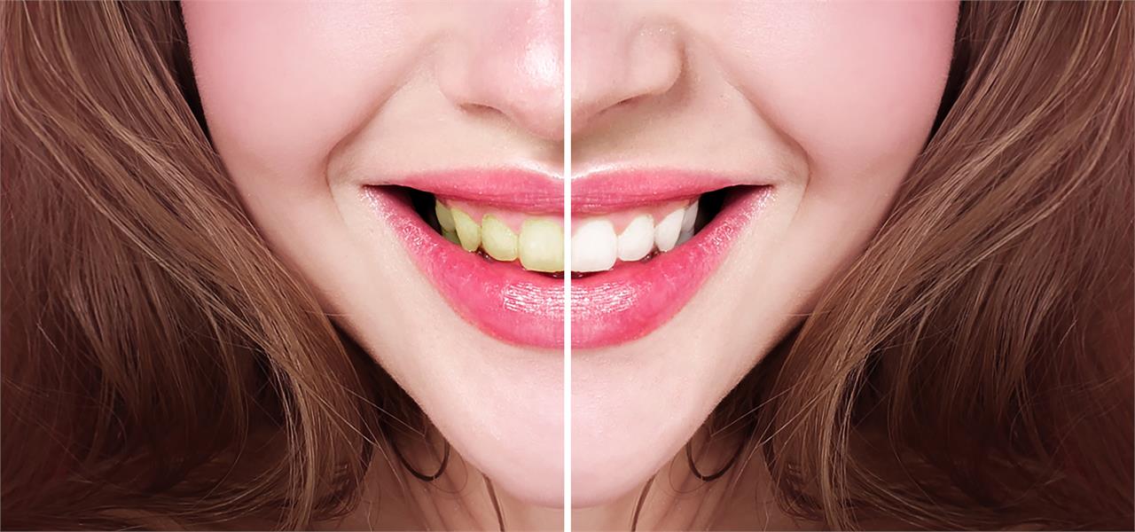 Los diferentes tipos de blanqueamientos dentales