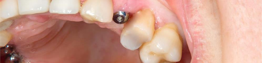 Implantes dentales en provincia Pontevedra